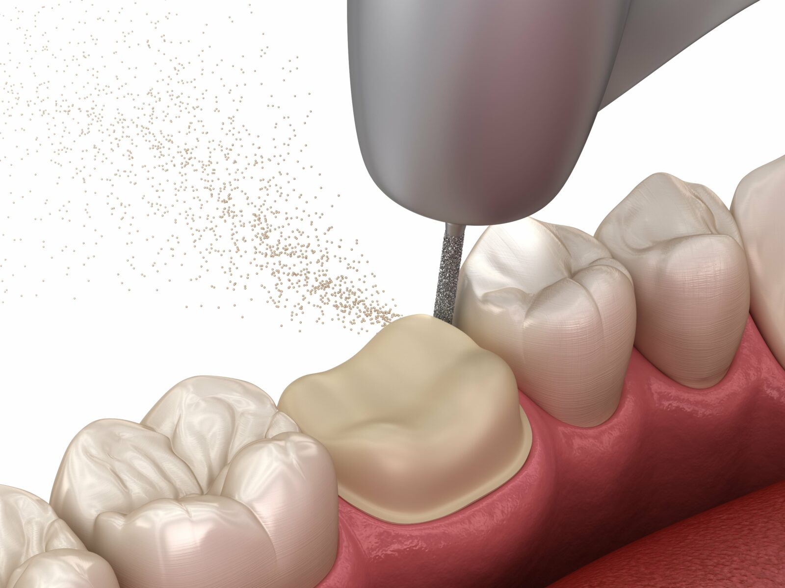 dental crown preparation