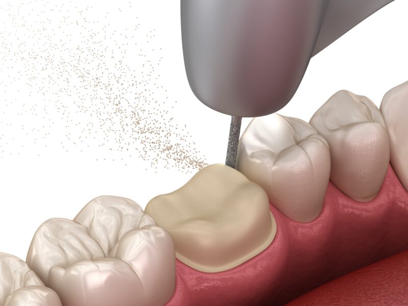 How Much Tooth is Needed for a Crown? Sedation Dental Care at Raleigh