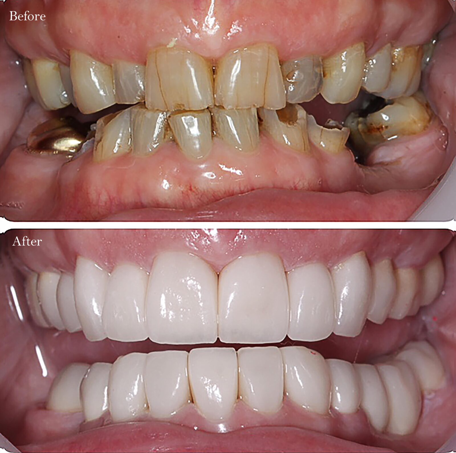 before and after dental implants