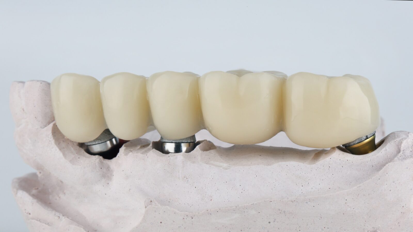 long dental bridge with three dental implants